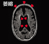 脳MRI撮影画像