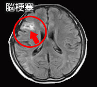 脳MRI撮影画像