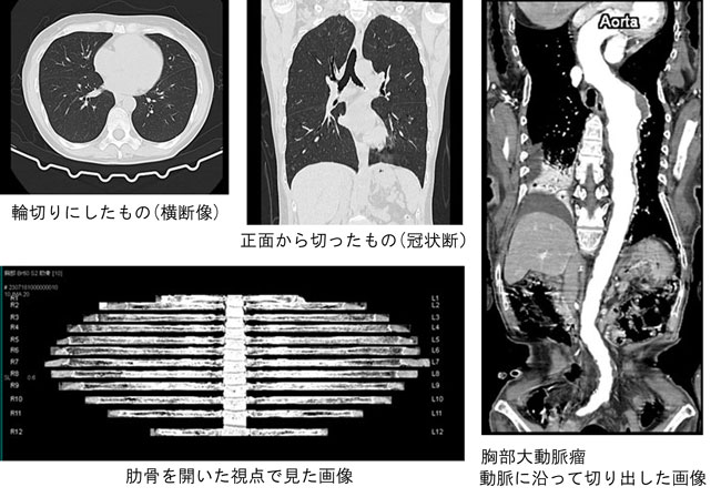 胸部CTの画像