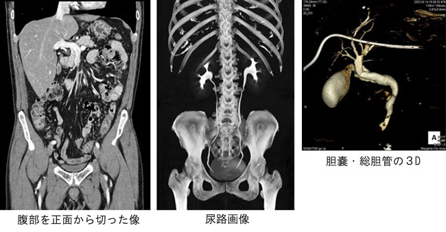 腹部CTの画像