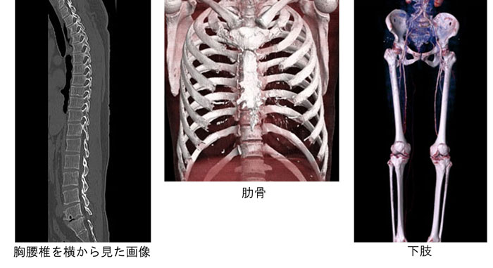 骨・四肢CTの画像