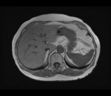 腹部MRI検査の画像