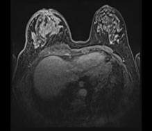 乳房MRIの画像