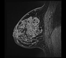 乳房MRIの画像