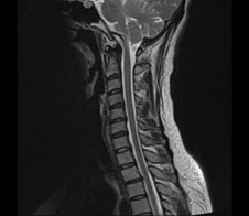 脊椎MRI検査の画像