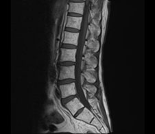 脊椎MRI検査の画像