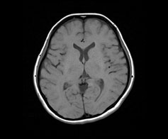 頭部MRI検査の画像