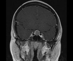 頭部MRI検査の画像