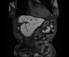 腹部MRI検査の画像