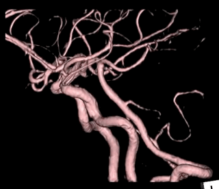 脳動脈の3D動脈瘤動画
