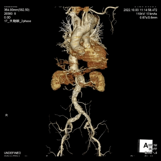 骨や血管などの3D解析動画